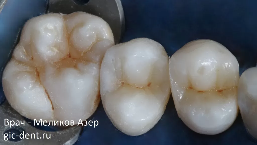 Реставрация боковой группы зубов 4,5 и 6 на верхней челюсти. Лечащий врач Меликов Азер Фуадович
